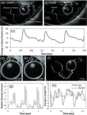New frontiers in intracranial imaging with HF-OCT: Ex vivo human cerebrovasculature evaluation and in vivo intracranial arteries dynamic visualization